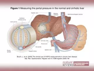 Figure 1 Measuring the portal pressure in the normal and cirrhotic liver