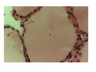 Colloid containing thyroglobulin / Stored thyroid hormone