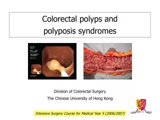 Colorectal polyps and polyposis syndromes