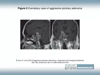 Figure 5 Exemplary case of aggressive pituitary adenoma