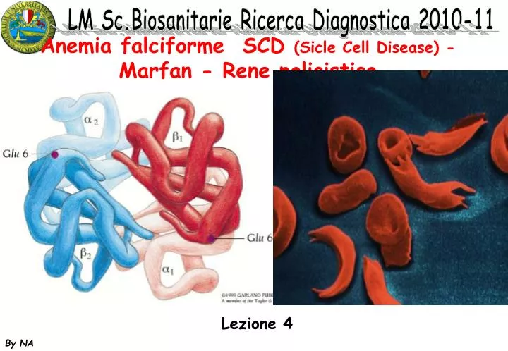 anemia falciforme scd sicle cell disease marfan rene policistico