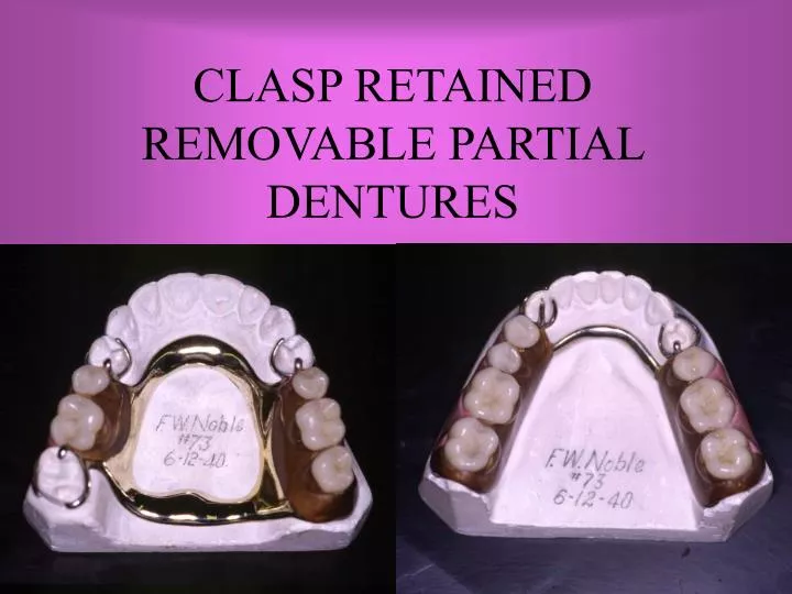 clasp retained removable partial dentures