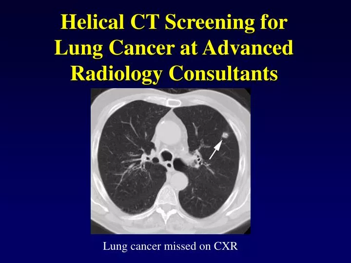 helical ct screening for lung cancer at advanced radiology consultants