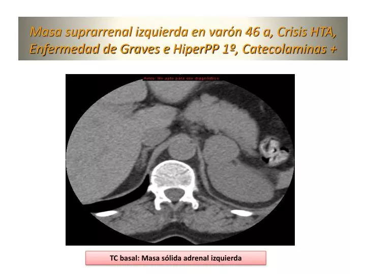 masa suprarrenal izquierda en var n 46 a crisis hta enfermedad de graves e hiperpp 1 catecolaminas