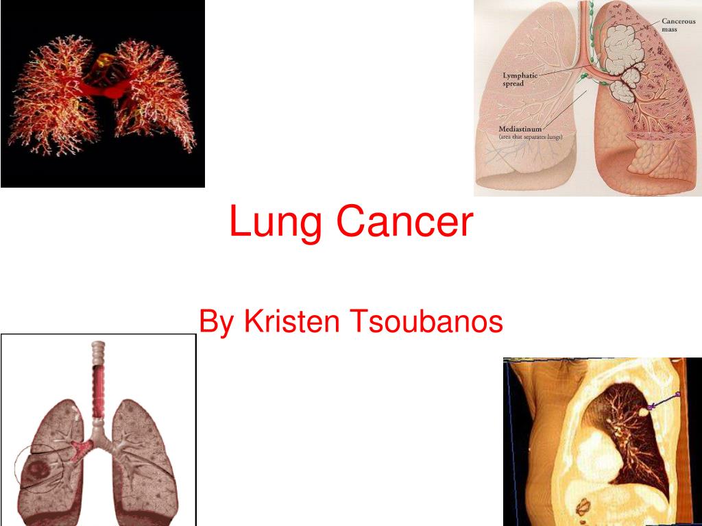 PPT - Lung Cancer PowerPoint Presentation, free download - ID:3665214