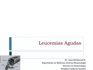 leucemias agudas