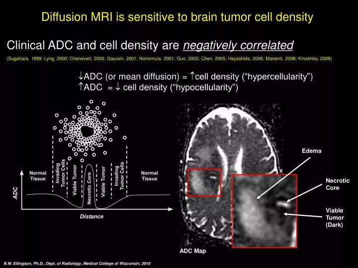 diffusion mri is sensitive to brain tumor cell density
