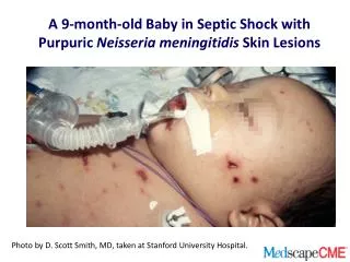 A 9-month-old Baby in Septic Shock with Purpuric Neisseria meningitidis Skin Lesions