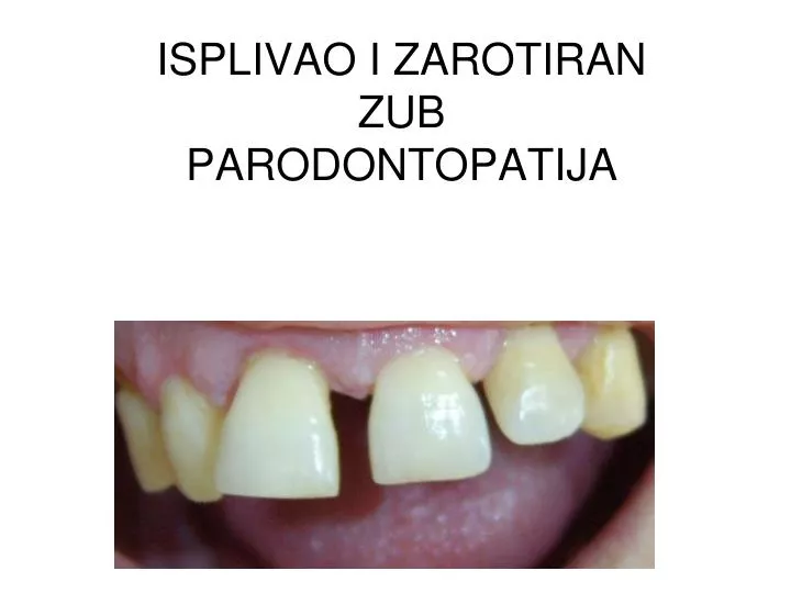 isplivao i zarotiran zub parodontopatija