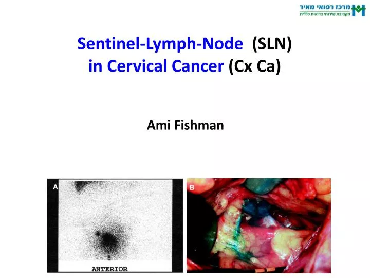 sentinel lymph node sln in cervical cancer cx ca