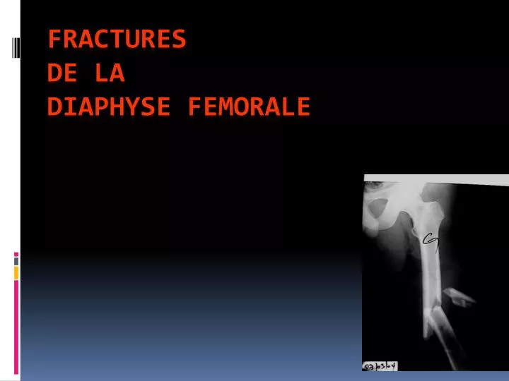 fractures de la diaphyse femorale