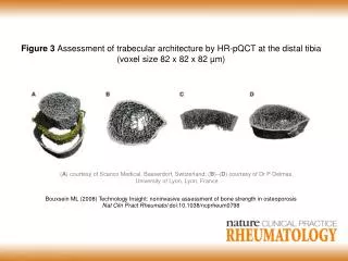 Bouxsein ML (2008) Technology Insight: noninvasive assessment of bone strength in osteoporosis