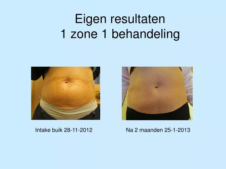 eigen resultaten 1 zone 1 behandeling