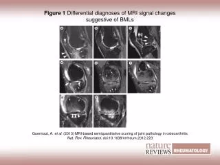 Figure 1 Differential diagnoses of MRI signal changes suggestive of BMLs