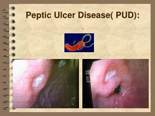 Peptic Ulcer Disease( PUD):