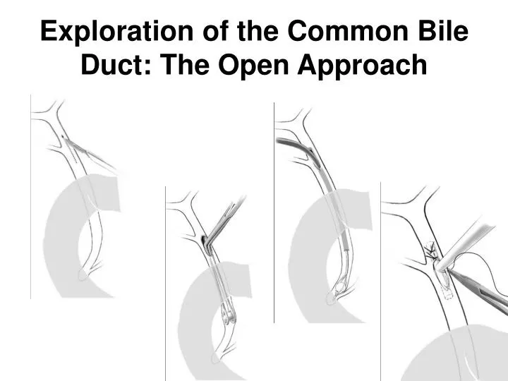 exploration of the common bile duct the open approach