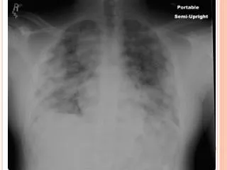 Hemoptysis ... Or That large testicular mass I’ve been ignoring