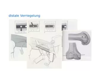 distale Verriegelung