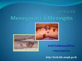 meningococcal meningitis
