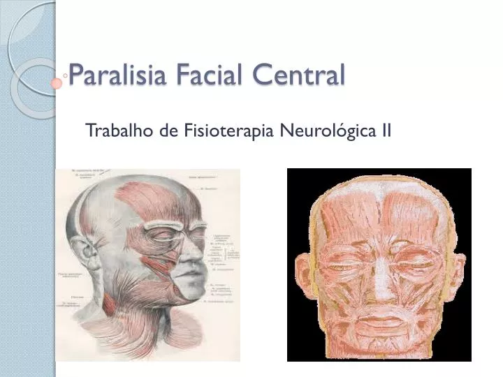 paralisia facial central