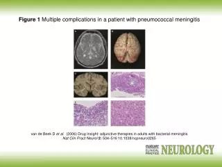 Figure 1 Multiple complications in a patient with pneumococcal meningitis
