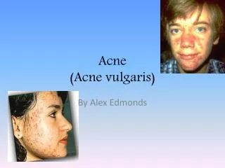 Acne (Acne vulgaris)