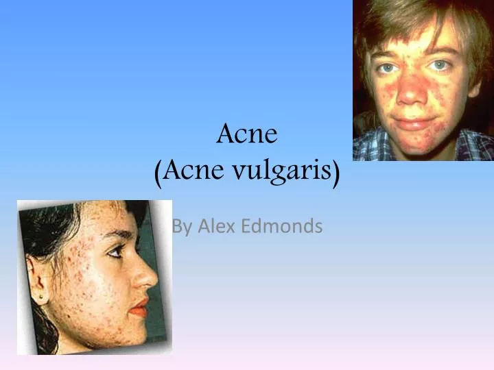 acne acne vulgaris
