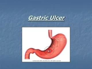 Gastric Ulcer