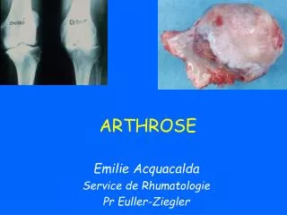 arthrose
