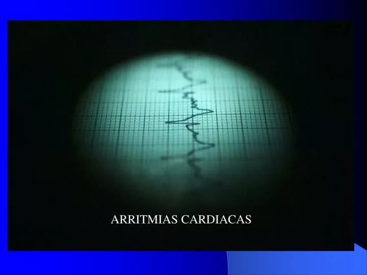 arritmias cardiacas