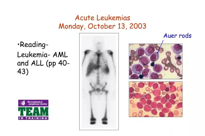 acute leukemias monday october 13 2003