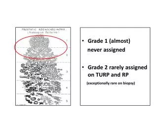 Grade 1 (almost) never assigned Grade 2 rarely assigned on TURP and RP