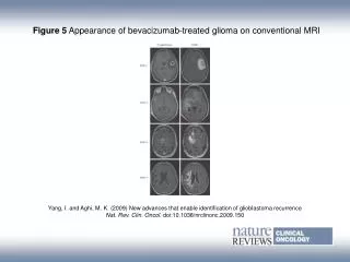 Figure 5 Appearance of bevacizumab?treated glioma on conventional MRI