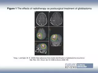 Figure 1 The effects of radiotherapy as postsurgical treatment of glioblastoma