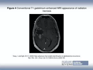 Figure 4 Conventional T1 gadolinium?enhanced MRI appearance of radiation necrosis