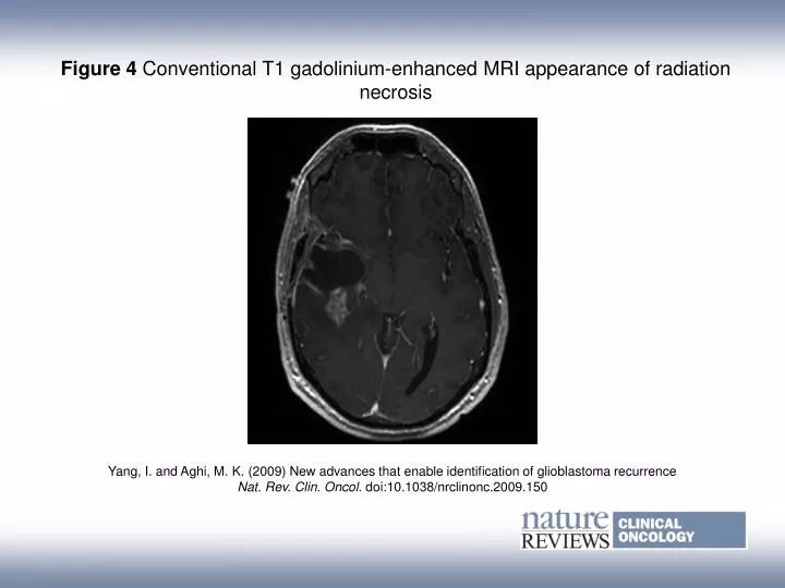 PPT - Figure 4 Conventional T1 gadolinium‑enhanced MRI appearance of ...