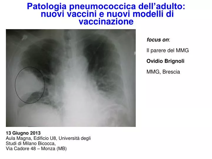 patologia pneumococcica dell adulto nuovi vaccini e nuovi modelli di vaccinazione
