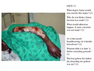 OSCE 13 What degree burns would you classify this injury? (2)