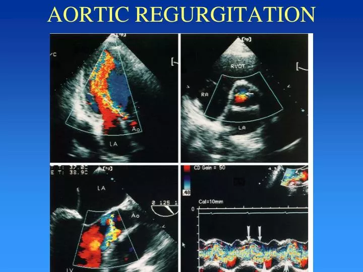 aortic regurgitation