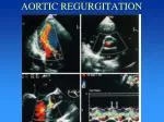 AORTIC REGURGITATION - slide 1