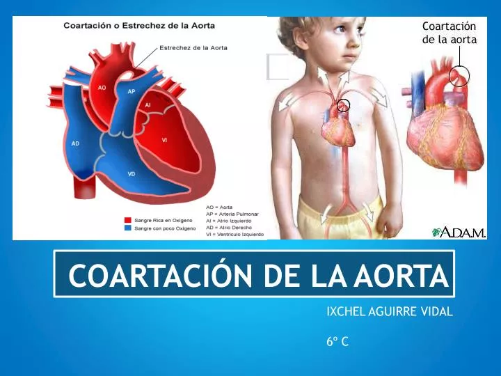 coartaci n de la aorta