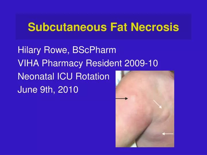 subcutaneous fat necrosis