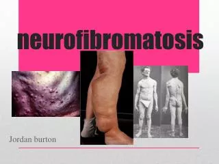 neurofibromatosis