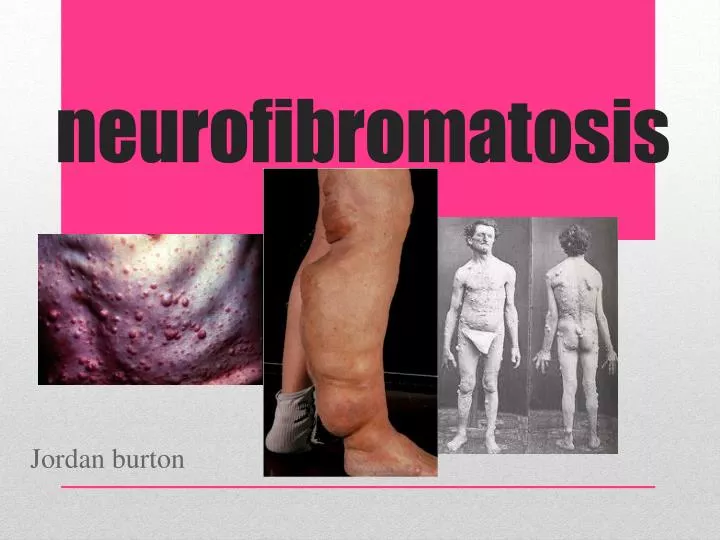 neurofibromatosis