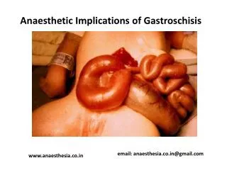 Anaesthetic Implications of Gastroschisis