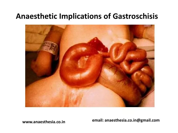 anaesthetic implications of gastroschisis