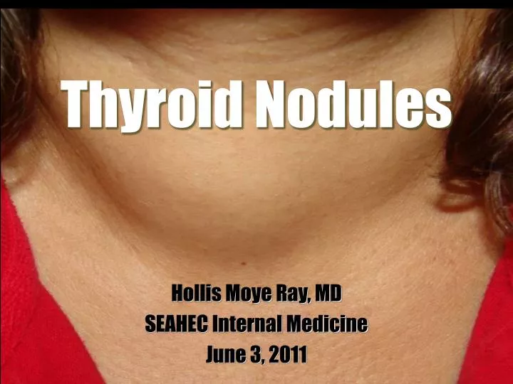 thyroid nodules