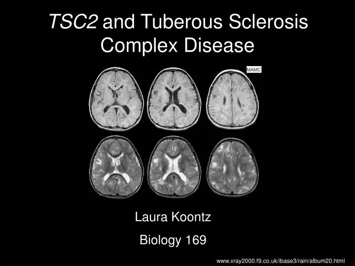 tsc2 and tuberous sclerosis complex disease