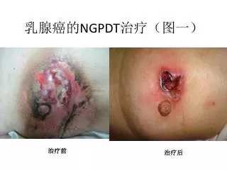 ngpdt
