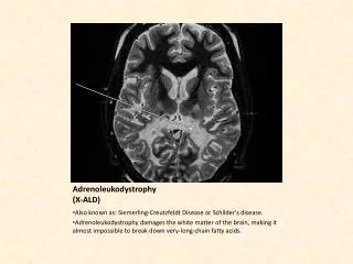 Adrenoleukodystrophy (X-ALD)